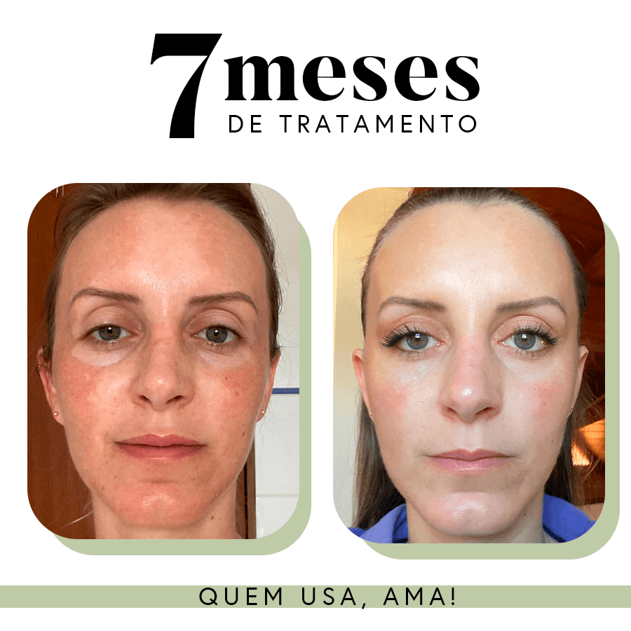 Ritual Essencial para Manchas e Linhas Finas (Uniformizadora + Renovadora)