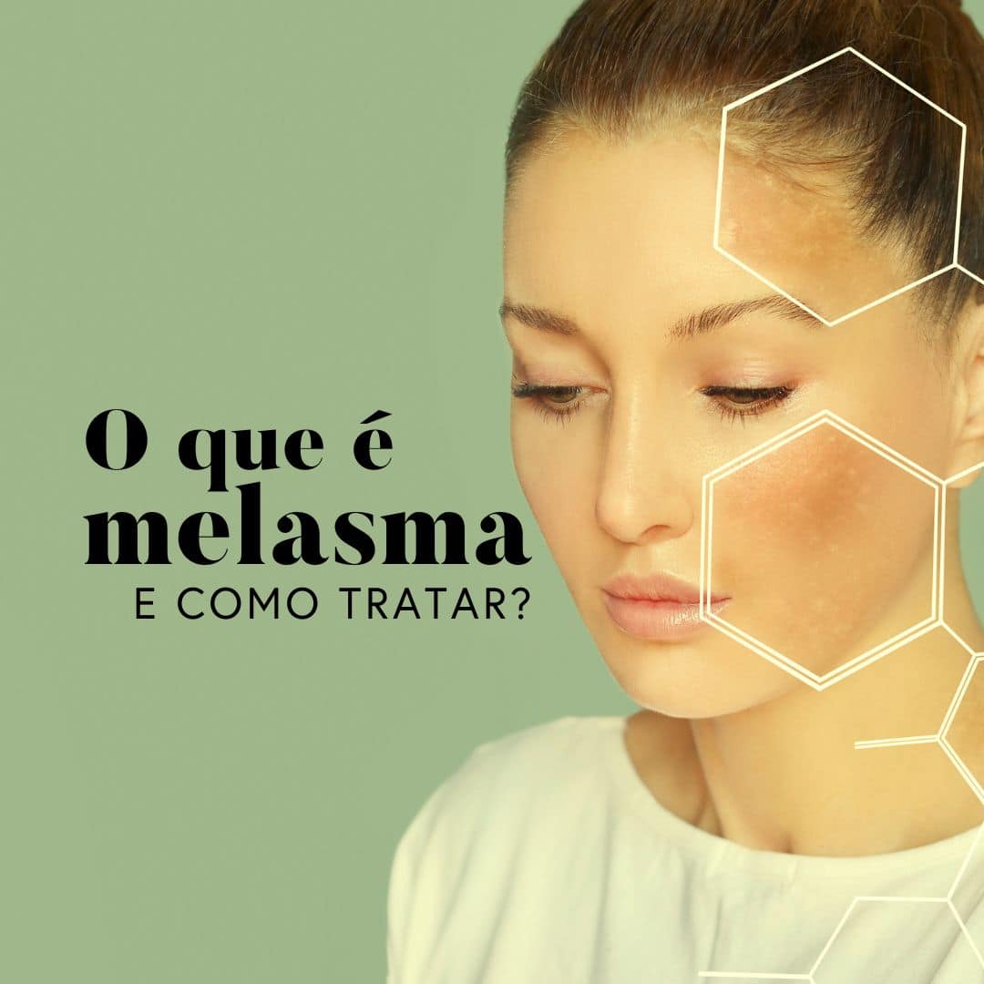 O que é melasma