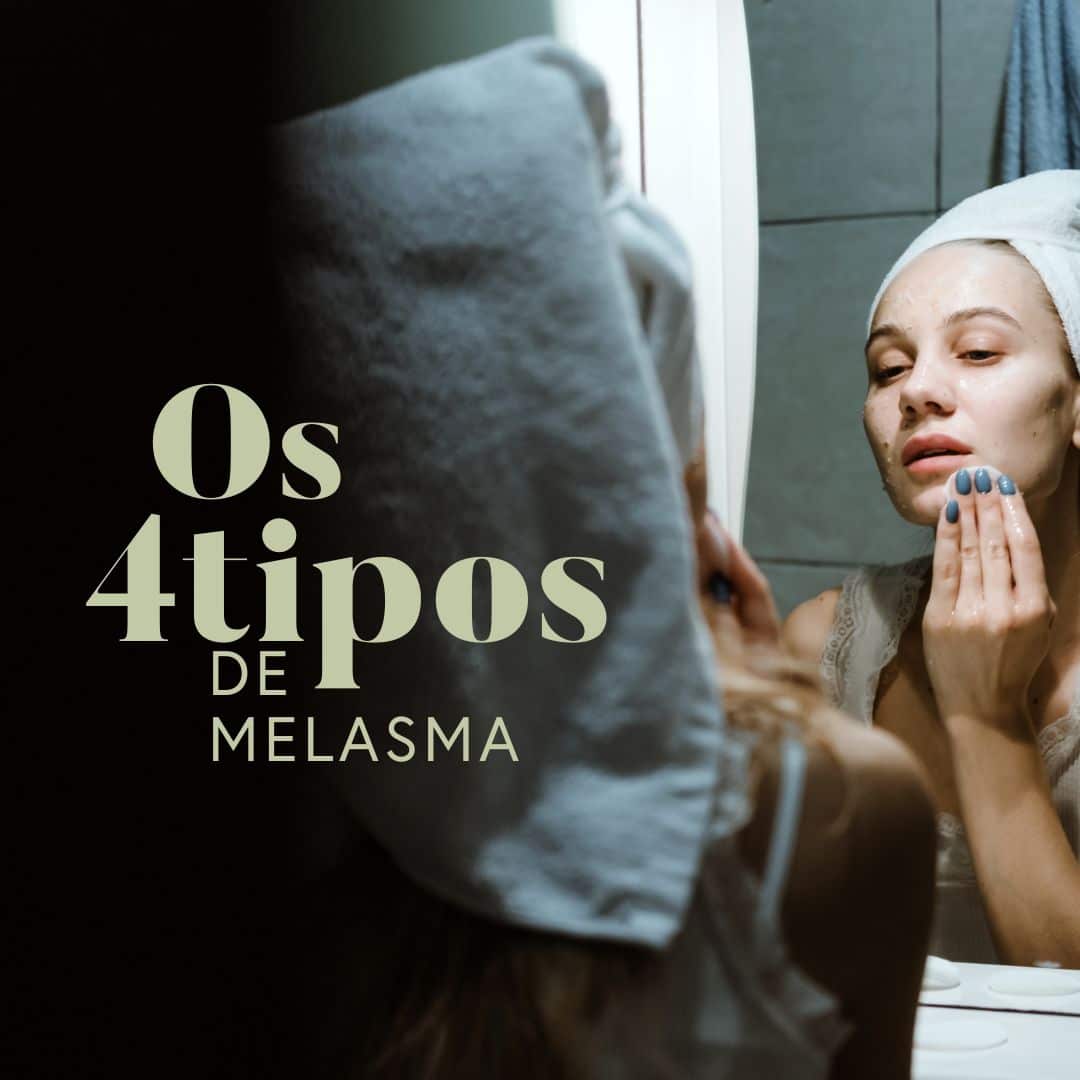 Tipos de melasma