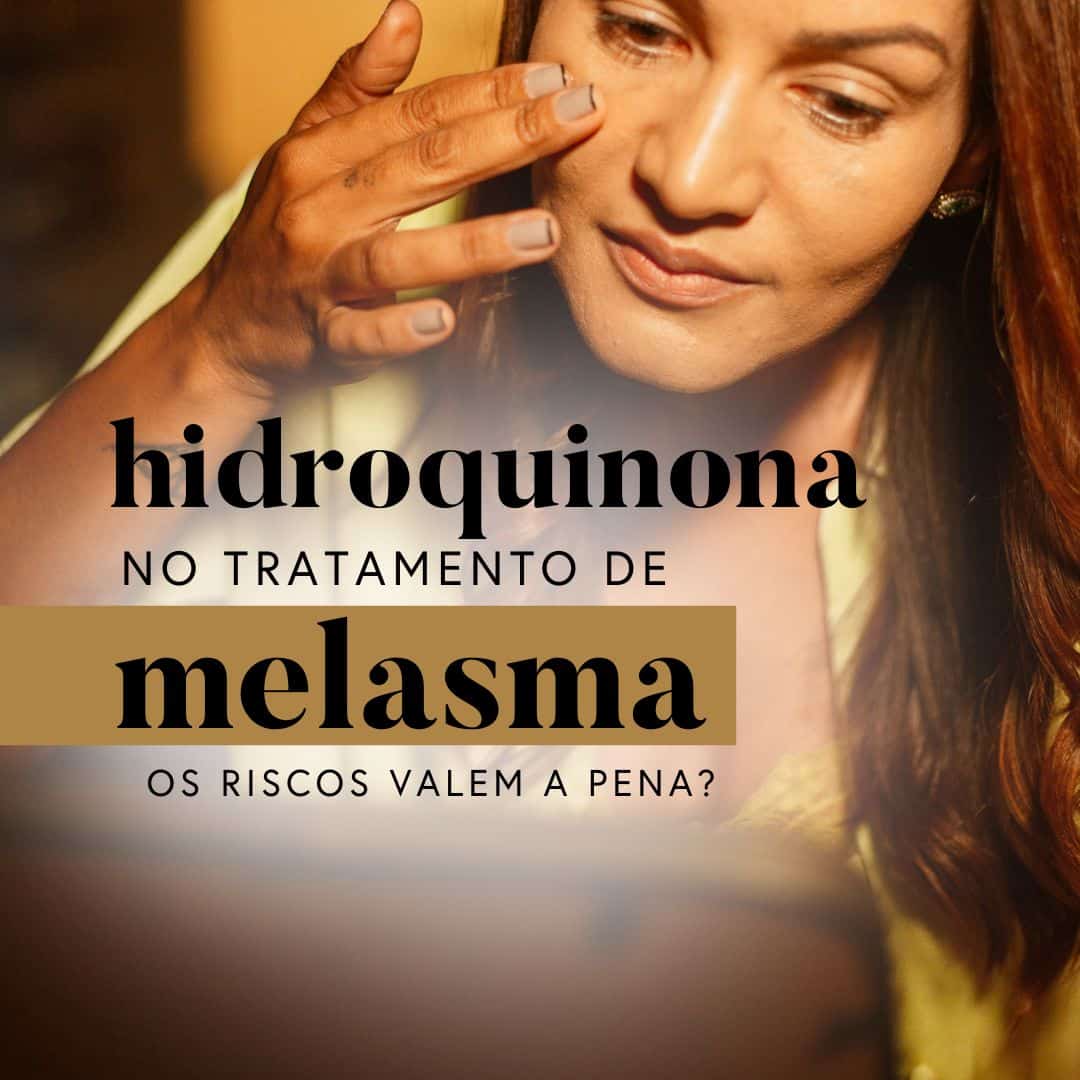 Hidroquinona no tratamento de melasma. Os riscos valem a pena?