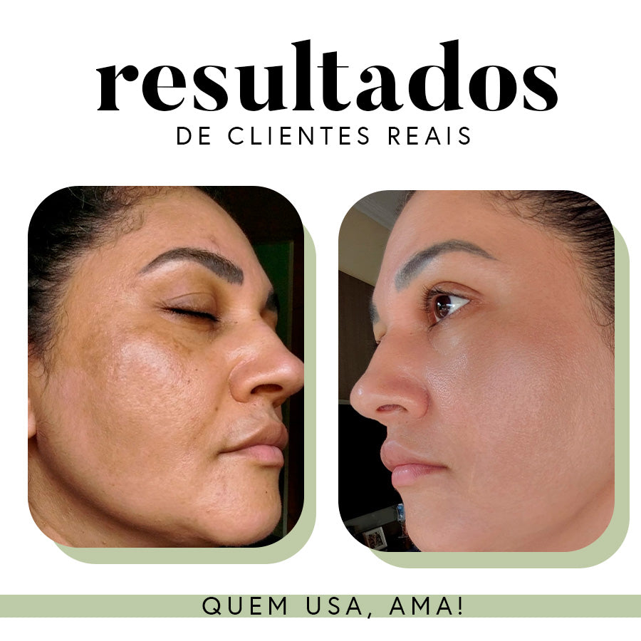 Ritual Essencial para Manchas e Melasma