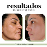 Ritual Essencial para Manchas e Melasma