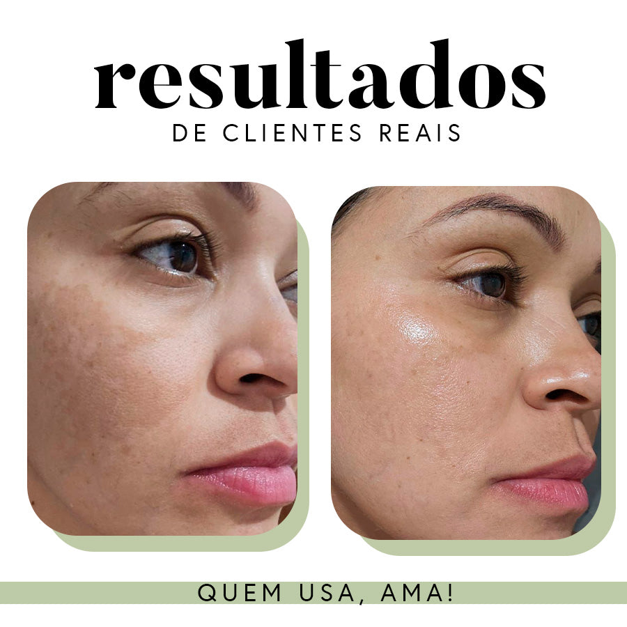 Ritual Essencial para Manchas e Melasma