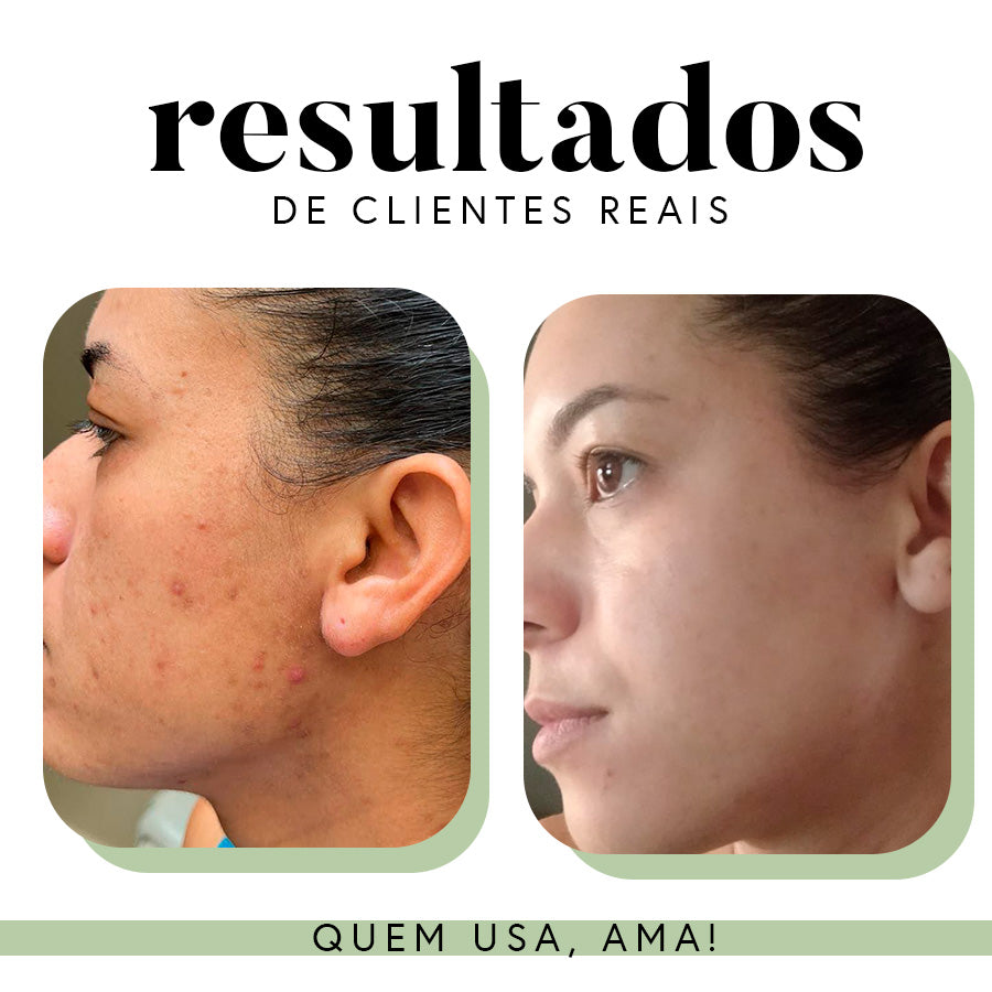 Ritual Essencial para Manchas e Melasma