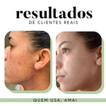Ritual Essencial para Manchas e Melasma