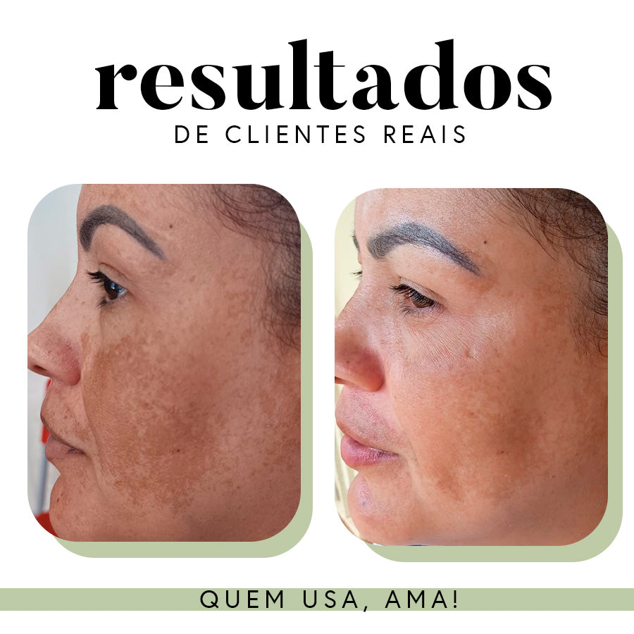 Ritual Essencial para Manchas e Melasma