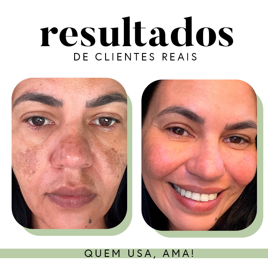 Ritual Essencial para Manchas e Melasma
