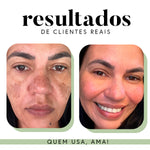 Ritual Essencial para Manchas e Melasma